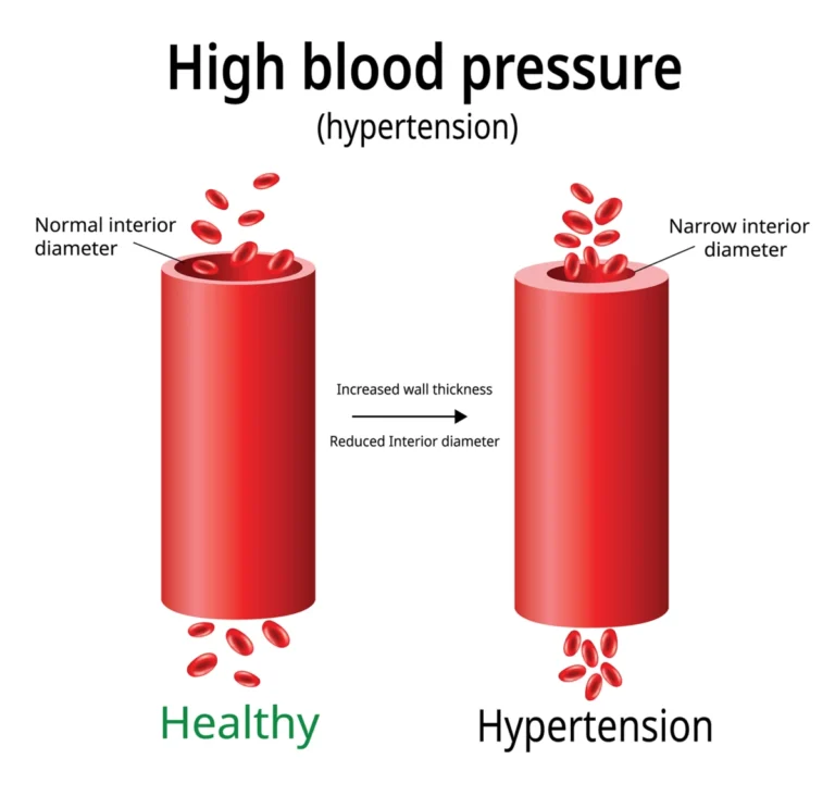 HYPERTENSION