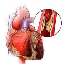 CARDIOVASCULAR DISEASE