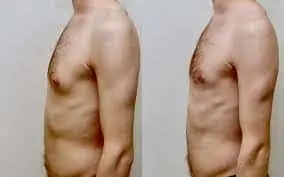 Chest Fat Or Gynecomastia