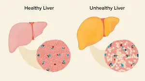 Fatty-liver-diseases