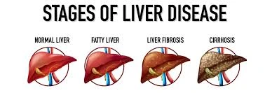 Liver disease caused by alcohol (ALD)