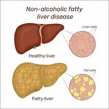 Nonalcoholic fatty liver disease