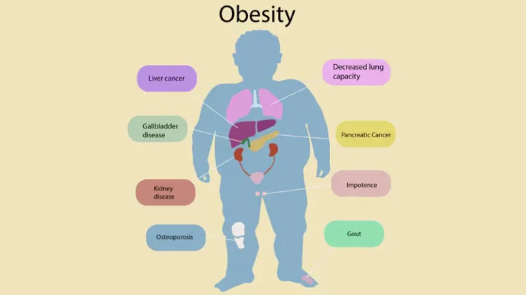 Obesity with comorbidities