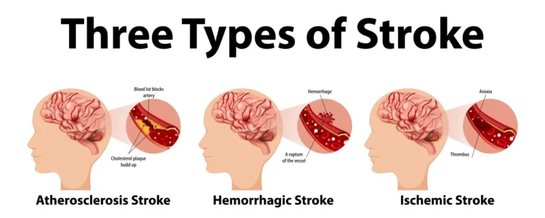 STROKE