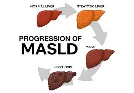 Steatosis liver disease linked to metabolic dysfunction (MASLD)