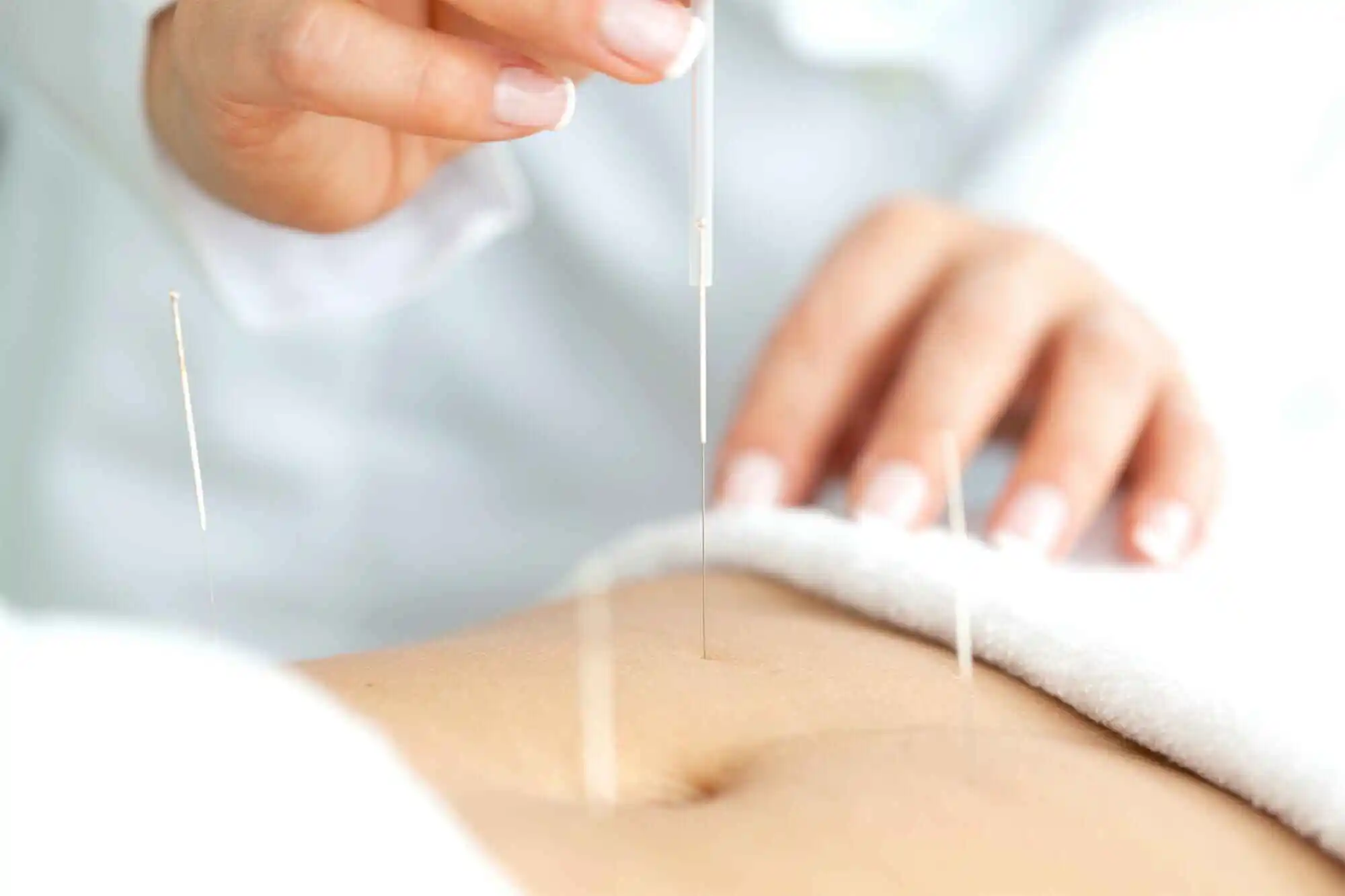 Acupuncture For Weight Loss