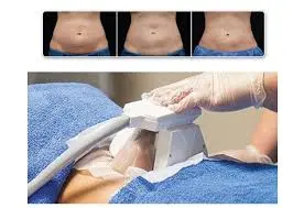 Fat freezing (cryolipolysis)