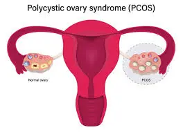 Ovarian polycystic syndrome