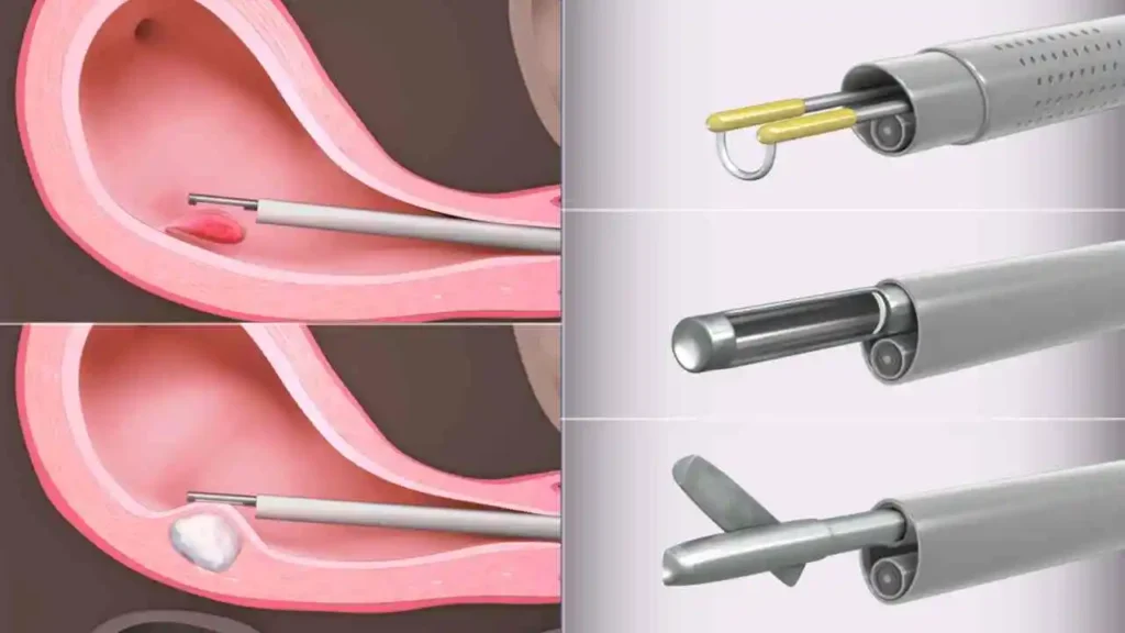 Method-of-Polyps-Removal