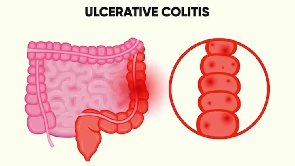 Ulcerative-Colitis