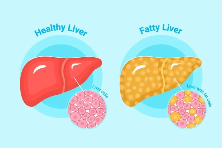 FATTY LIVER