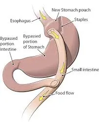 gastric bypass surgery