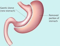 sleeve gastrectomy