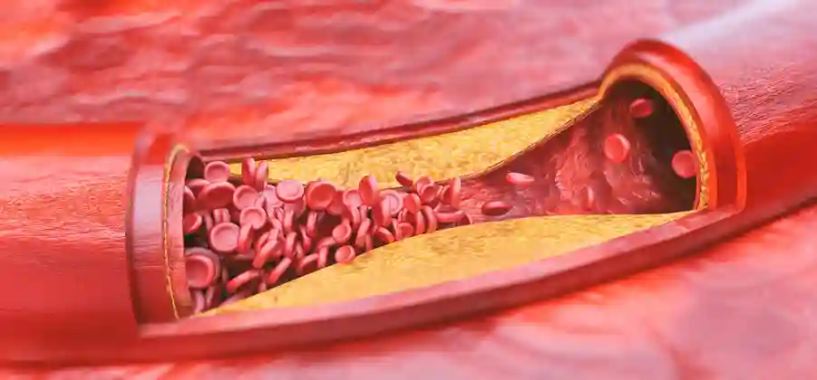 Atherosclerosis