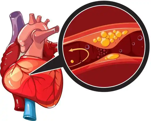 ischmeic-heart-diseases