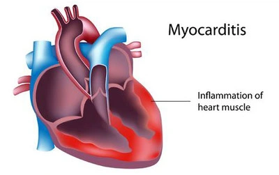 myocarditis