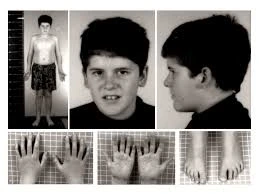 Prader- willi syndrome